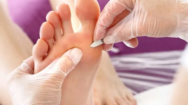 A podiatrist wearing gloves uses a small scalpel to treat a patient's foot.