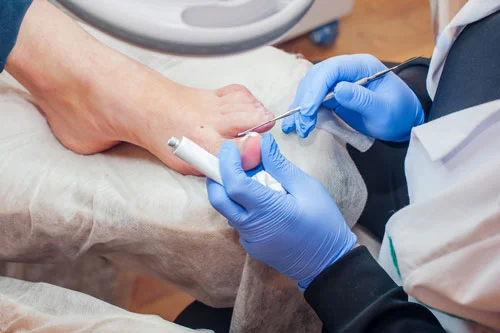 Home 6 A podiatrist wearing blue gloves is performing toenail surgery on a patient's foot. The procedure involves the use of a surgical tool and another instrument to treat the toenail. The patient is seated with their foot elevated and supported on a padded surface.